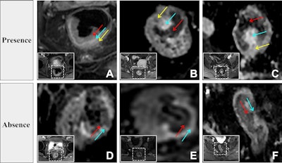 Evaluation of the dark-light-dark sign from contrast-enhanced T1-weighted images. The inset white solid and dashed boxes show the locations of the tumors. (A-C) Presence of the three-layered dark-light-dark sign, characterized sequentially by slight enhancement of the tumor (red arrow), obvious strip-shaped enhancement (blue arrow), and slight enhancement of the muscularis propria layer (yellow arrow). (D-F) Absence of the dark-light-dark sign. Only two layers are observed: the first dark layer (red arrow) and the light layer (blue arrow). The third dark layer -- slight enhancement of the muscularis propria layer -- is absent.