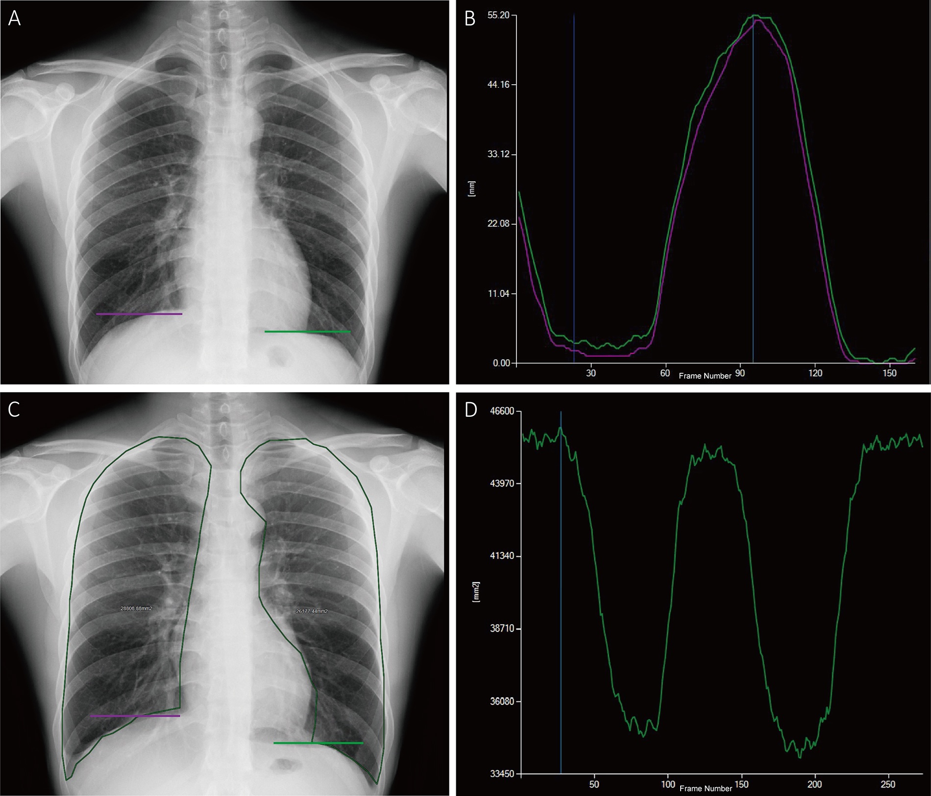 Tracking and quantitative analysis of diaphragmatic motion and projected lung area (PLA) at dynamic chest radiography (DCR) in a 55-year-old healthy man during deep breathing. (A) Posteroanterior radiograph with purple and green lines indicating the right and left lateral diaphragm apices, respectively. (B) Graph of diaphragmatic motion (in millimeters; y-axis) over time (i.e., frame number; x-axis). The software tracked the position of the diaphragm apex at DCR to obtain these amplitude-time plots of diaphragmatic motion (right lung, purple; left lung, green). The dark blue line corresponds to the frame representing the end of inspiration; the light blue line corresponds to the frame representing the end of expiration. (C) Posteroanterior radiograph shows the PLA (outline), which is the area surrounded by the medial edge of the ribs, the diaphragm, and the edge of the mediastinum. (D) Graph of PLA (in millimeters squared; y-axis) over time (i.e., frame number; x-axis). The software automatically tracked the boundaries of the lung fields and obtained the time-varying curves of the bilateral lung field areas. The blue line corresponds to the frame representing the end of inspiration.