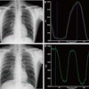 Tracking and quantitative analysis of diaphragmatic motion and projected lung area (PLA) at dynamic chest radiography (DCR) in a 55-year-old healthy man during deep breathing. (A) Posteroanterior radiograph with purple and green lines indicating the right and left lateral diaphragm apices, respectively. (B) Graph of diaphragmatic motion (in millimeters; y-axis) over time (i.e., frame number; x-axis). The software tracked the position of the diaphragm apex at DCR to obtain these amplitude-time plots of diaphragmatic motion (right lung, purple; left lung, green). The dark blue line corresponds to the frame representing the end of inspiration; the light blue line corresponds to the frame representing the end of expiration. (C) Posteroanterior radiograph shows the PLA (outline), which is the area surrounded by the medial edge of the ribs, the diaphragm, and the edge of the mediastinum. (D) Graph of PLA (in millimeters squared; y-axis) over time (i.e., frame number; x-axis). The software automatically tracked the boundaries of the lung fields and obtained the time-varying curves of the bilateral lung field areas. The blue line corresponds to the frame representing the end of inspiration.