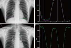 Tracking and quantitative analysis of diaphragmatic motion and projected lung area (PLA) at dynamic chest radiography (DCR) in a 55-year-old healthy man during deep breathing. (A) Posteroanterior radiograph with purple and green lines indicating the right and left lateral diaphragm apices, respectively. (B) Graph of diaphragmatic motion (in millimeters; y-axis) over time (i.e., frame number; x-axis). The software tracked the position of the diaphragm apex at DCR to obtain these amplitude-time plots of diaphragmatic motion (right lung, purple; left lung, green). The dark blue line corresponds to the frame representing the end of inspiration; the light blue line corresponds to the frame representing the end of expiration. (C) Posteroanterior radiograph shows the PLA (outline), which is the area surrounded by the medial edge of the ribs, the diaphragm, and the edge of the mediastinum. (D) Graph of PLA (in millimeters squared; y-axis) over time (i.e., frame number; x-axis). The software automatically tracked the boundaries of the lung fields and obtained the time-varying curves of the bilateral lung field areas. The blue line corresponds to the frame representing the end of inspiration.