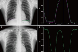 Tracking and quantitative analysis of diaphragmatic motion and projected lung area (PLA) at dynamic chest radiography (DCR) in a 55-year-old healthy man during deep breathing. (A) Posteroanterior radiograph with purple and green lines indicating the right and left lateral diaphragm apices, respectively. (B) Graph of diaphragmatic motion (in millimeters; y-axis) over time (i.e., frame number; x-axis). The software tracked the position of the diaphragm apex at DCR to obtain these amplitude-time plots of diaphragmatic motion (right lung, purple; left lung, green). The dark blue line corresponds to the frame representing the end of inspiration; the light blue line corresponds to the frame representing the end of expiration. (C) Posteroanterior radiograph shows the PLA (outline), which is the area surrounded by the medial edge of the ribs, the diaphragm, and the edge of the mediastinum. (D) Graph of PLA (in millimeters squared; y-axis) over time (i.e., frame number; x-axis). The software automatically tracked the boundaries of the lung fields and obtained the time-varying curves of the bilateral lung field areas. The blue line corresponds to the frame representing the end of inspiration.