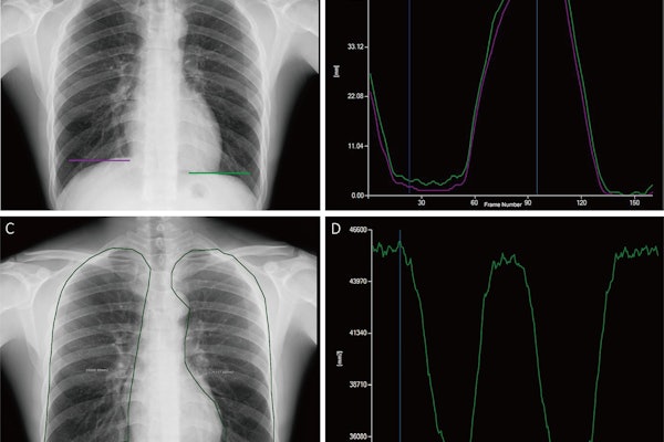 Tracking and quantitative analysis of diaphragmatic motion and projected lung area (PLA) at dynamic chest radiography (DCR) in a 55-year-old healthy man during deep breathing. (A) Posteroanterior radiograph with purple and green lines indicating the right and left lateral diaphragm apices, respectively. (B) Graph of diaphragmatic motion (in millimeters; y-axis) over time (i.e., frame number; x-axis). The software tracked the position of the diaphragm apex at DCR to obtain these amplitude-time plots of diaphragmatic motion (right lung, purple; left lung, green). The dark blue line corresponds to the frame representing the end of inspiration; the light blue line corresponds to the frame representing the end of expiration. (C) Posteroanterior radiograph shows the PLA (outline), which is the area surrounded by the medial edge of the ribs, the diaphragm, and the edge of the mediastinum. (D) Graph of PLA (in millimeters squared; y-axis) over time (i.e., frame number; x-axis). The software automatically tracked the boundaries of the lung fields and obtained the time-varying curves of the bilateral lung field areas. The blue line corresponds to the frame representing the end of inspiration.