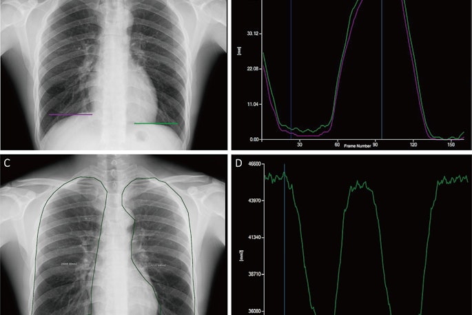 Tracking and quantitative analysis of diaphragmatic motion and projected lung area (PLA) at dynamic chest radiography (DCR) in a 55-year-old healthy man during deep breathing. (A) Posteroanterior radiograph with purple and green lines indicating the right and left lateral diaphragm apices, respectively. (B) Graph of diaphragmatic motion (in millimeters; y-axis) over time (i.e., frame number; x-axis). The software tracked the position of the diaphragm apex at DCR to obtain these amplitude-time plots of diaphragmatic motion (right lung, purple; left lung, green). The dark blue line corresponds to the frame representing the end of inspiration; the light blue line corresponds to the frame representing the end of expiration. (C) Posteroanterior radiograph shows the PLA (outline), which is the area surrounded by the medial edge of the ribs, the diaphragm, and the edge of the mediastinum. (D) Graph of PLA (in millimeters squared; y-axis) over time (i.e., frame number; x-axis). The software automatically tracked the boundaries of the lung fields and obtained the time-varying curves of the bilateral lung field areas. The blue line corresponds to the frame representing the end of inspiration.