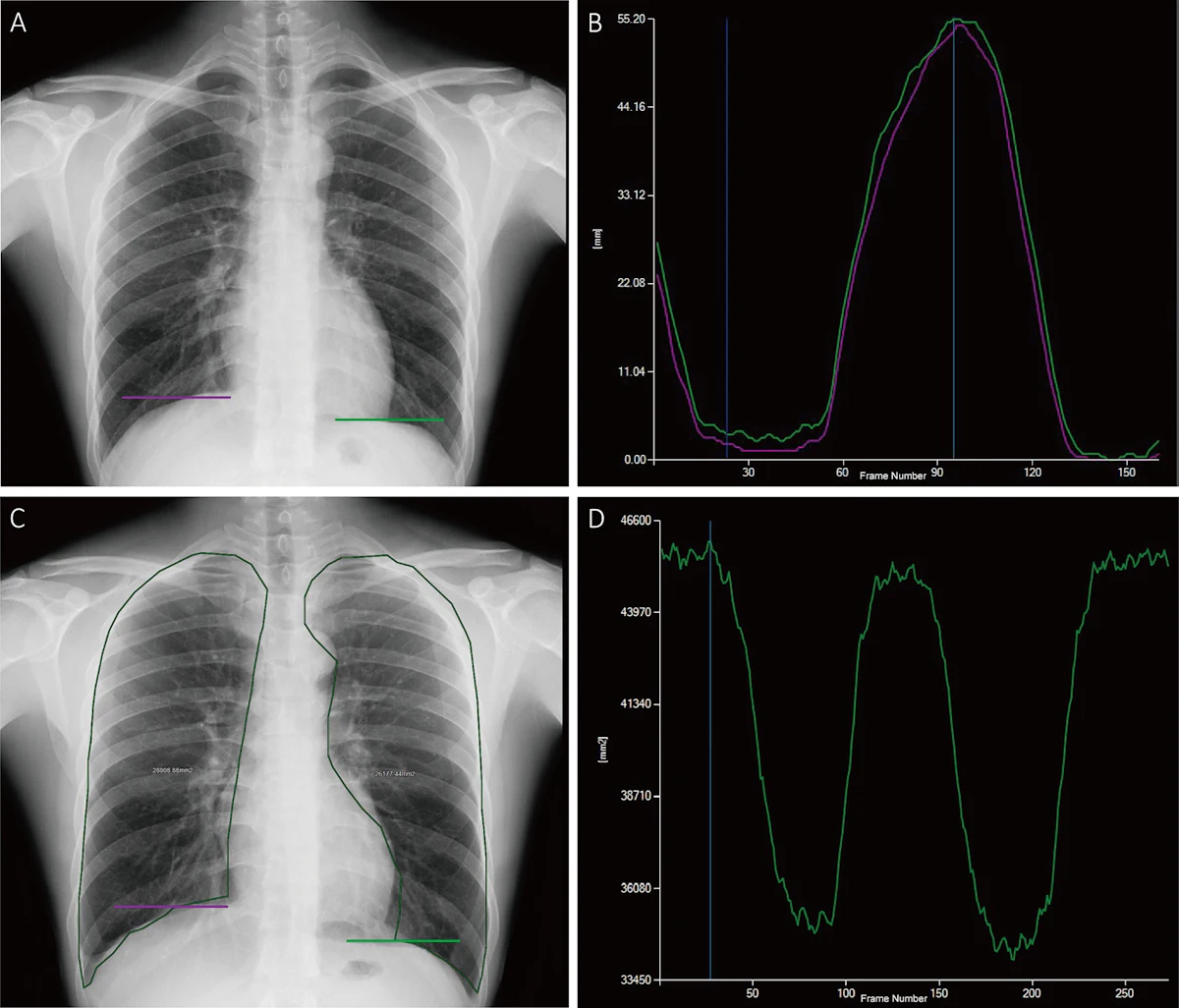 Dynamic chest radiography effective for diagnosing COPD | AuntMinnie