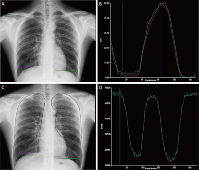 Tracking and quantitative analysis of diaphragmatic motion and projected lung area (PLA) at dynamic chest radiography (DCR) in a 55-year-old healthy man during deep breathing. (A) Posteroanterior radiograph with purple and green lines indicating the right and left lateral diaphragm apices, respectively. (B) Graph of diaphragmatic motion (in millimeters; y-axis) over time (i.e., frame number; x-axis). The software tracked the position of the diaphragm apex at DCR to obtain these amplitude-time plots of diaphragmatic motion (right lung, purple; left lung, green). The dark blue line corresponds to the frame representing the end of inspiration; the light blue line corresponds to the frame representing the end of expiration. (C) Posteroanterior radiograph shows the PLA (outline), which is the area surrounded by the medial edge of the ribs, the diaphragm, and the edge of the mediastinum. (D) Graph of PLA (in millimeters squared; y-axis) over time (i.e., frame number; x-axis). The software automatically tracked the boundaries of the lung fields and obtained the time-varying curves of the bilateral lung field areas. The blue line corresponds to the frame representing the end of inspiration.