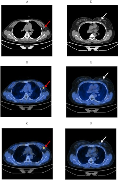 The characteristic imaging features of high-risk breast lesions on early and late F-18 FAPI-04 PET/CT. (A, D) are CT images; (B, E) are early imaging fused images; (C, F) are late imaging fused images. (A–C) A 35-year-old patient diagnosed with invasive ductal carcinoma, as indicated by the red arrow, with ultrasound findings classified as BI-RADS 4a. In the early and late imaging, the maximum standard uptake value (SUVmax) (12.5 vs. 14.2), lesion-to-background ratio (LBR) (22.2 vs. 22.2), respectively. (D–F) A 51-year-old patient with a breast fibroadenoma, as indicated by the white arrow, also categorized as BI-RADS 4a. In the early and late imaging, the SUVmax (0.5 vs. 1.1), LBR (2.2 vs. 2.6), respectively. These findings demonstrate that both SUVmax and LBR in breast cancer are markedly higher than those in benign breast lesions across both imaging phases.