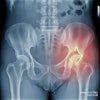 Hip Fracture X Ray