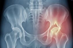 Hip Fracture X Ray