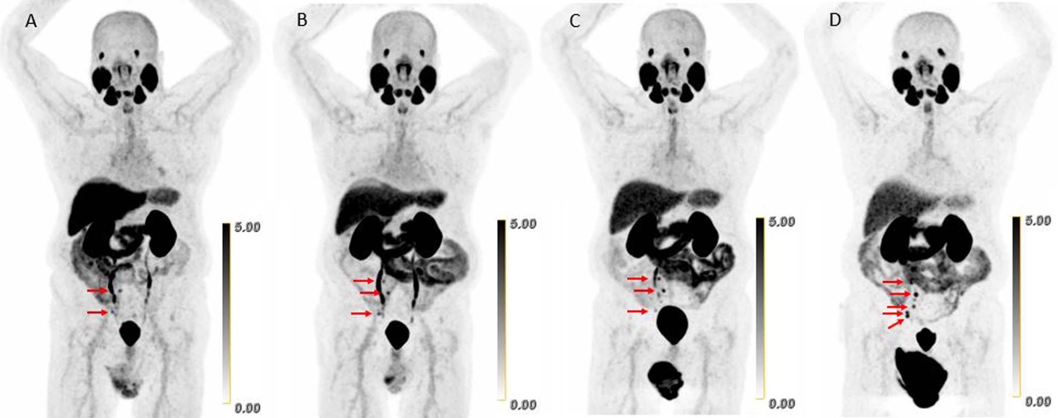 Scans in a 73-year-old man with biochemically recurrent prostate cancer (prostate-specific antigen level of 0.5 ng/mL) who underwent PET/CT with 9.4 mCi of F-18 piflufolastat and a second PET/CT examination with 8.1 mCi of copper 61-NODAGA (1,4,7-triazacyclononane,1-glutaric acid-4,7-acetic acid)&ndash;prostate-specific membrane antigen for imaging and therapy (Cu-61 PSMA I&amp;T) 24 days apart, with no intervening therapy. Maximum intensity projection (MIP) images obtained (A) 1 hour after F-18 piflufolastat administration and (B) 1, (C) 2, and (D) 4 hours after Cu-61 PSMA I&amp;T administration are shown. Physiologic uptake is seen in the lacrimal glands, salivary glands, liver, spleen, kidneys, ureters, and bladder. Pathologic uptake in pelvic nodal metastases is labeled with arrows. The F-18 piflufolastat PET/CT MIP image reveals two avid pelvic nodal metastases (arrows). Cu-61 PSMA I&amp;T PET/CT scans demonstrate three avid pelvic nodal metastases on 1-hour and 2-hour images (arrows); five avid pelvic nodal metastases were suspected on the 4-hour image (arrows).
