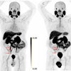Scans in a 73-year-old man with biochemically recurrent prostate cancer (prostate-specific antigen level of 0.5 ng/mL) who underwent PET/CT with 9.4 mCi of F-18 piflufolastat and a second PET/CT examination with 8.1 mCi of copper 61-NODAGA (1,4,7-triazacyclononane,1-glutaric acid-4,7-acetic acid)–prostate-specific membrane antigen for imaging and therapy (Cu-61 PSMA I&T) 24 days apart, with no intervening therapy. Maximum intensity projection (MIP) images obtained (A) 1 hour after F-18 piflufolastat administration and (B) 1, (C) 2, and (D) 4 hours after Cu-61 PSMA I&T administration are shown. Physiologic uptake is seen in the lacrimal glands, salivary glands, liver, spleen, kidneys, ureters, and bladder. Pathologic uptake in pelvic nodal metastases is labeled with arrows. The F-18 piflufolastat PET/CT MIP image reveals two avid pelvic nodal metastases (arrows). Cu-61 PSMA I&T PET/CT scans demonstrate three avid pelvic nodal metastases on 1-hour and 2-hour images (arrows); five avid pelvic nodal metastases were suspected on the 4-hour image (arrows).