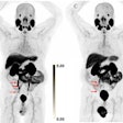Scans in a 73-year-old man with biochemically recurrent prostate cancer (prostate-specific antigen level of 0.5 ng/mL) who underwent PET/CT with 9.4 mCi of F-18 piflufolastat and a second PET/CT examination with 8.1 mCi of copper 61-NODAGA (1,4,7-triazacyclononane,1-glutaric acid-4,7-acetic acid)–prostate-specific membrane antigen for imaging and therapy (Cu-61 PSMA I&T) 24 days apart, with no intervening therapy. Maximum intensity projection (MIP) images obtained (A) 1 hour after F-18 piflufolastat administration and (B) 1, (C) 2, and (D) 4 hours after Cu-61 PSMA I&T administration are shown. Physiologic uptake is seen in the lacrimal glands, salivary glands, liver, spleen, kidneys, ureters, and bladder. Pathologic uptake in pelvic nodal metastases is labeled with arrows. The F-18 piflufolastat PET/CT MIP image reveals two avid pelvic nodal metastases (arrows). Cu-61 PSMA I&T PET/CT scans demonstrate three avid pelvic nodal metastases on 1-hour and 2-hour images (arrows); five avid pelvic nodal metastases were suspected on the 4-hour image (arrows).