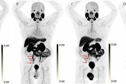 Scans in a 73-year-old man with biochemically recurrent prostate cancer (prostate-specific antigen level of 0.5 ng/mL) who underwent PET/CT with 9.4 mCi of F-18 piflufolastat and a second PET/CT examination with 8.1 mCi of copper 61-NODAGA (1,4,7-triazacyclononane,1-glutaric acid-4,7-acetic acid)–prostate-specific membrane antigen for imaging and therapy (Cu-61 PSMA I&T) 24 days apart, with no intervening therapy. Maximum intensity projection (MIP) images obtained (A) 1 hour after F-18 piflufolastat administration and (B) 1, (C) 2, and (D) 4 hours after Cu-61 PSMA I&T administration are shown. Physiologic uptake is seen in the lacrimal glands, salivary glands, liver, spleen, kidneys, ureters, and bladder. Pathologic uptake in pelvic nodal metastases is labeled with arrows. The F-18 piflufolastat PET/CT MIP image reveals two avid pelvic nodal metastases (arrows). Cu-61 PSMA I&T PET/CT scans demonstrate three avid pelvic nodal metastases on 1-hour and 2-hour images (arrows); five avid pelvic nodal metastases were suspected on the 4-hour image (arrows).