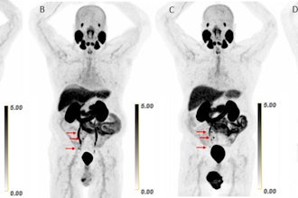 Scans in a 73-year-old man with biochemically recurrent prostate cancer (prostate-specific antigen level of 0.5 ng/mL) who underwent PET/CT with 9.4 mCi of F-18 piflufolastat and a second PET/CT examination with 8.1 mCi of copper 61-NODAGA (1,4,7-triazacyclononane,1-glutaric acid-4,7-acetic acid)–prostate-specific membrane antigen for imaging and therapy (Cu-61 PSMA I&T) 24 days apart, with no intervening therapy. Maximum intensity projection (MIP) images obtained (A) 1 hour after F-18 piflufolastat administration and (B) 1, (C) 2, and (D) 4 hours after Cu-61 PSMA I&T administration are shown. Physiologic uptake is seen in the lacrimal glands, salivary glands, liver, spleen, kidneys, ureters, and bladder. Pathologic uptake in pelvic nodal metastases is labeled with arrows. The F-18 piflufolastat PET/CT MIP image reveals two avid pelvic nodal metastases (arrows). Cu-61 PSMA I&T PET/CT scans demonstrate three avid pelvic nodal metastases on 1-hour and 2-hour images (arrows); five avid pelvic nodal metastases were suspected on the 4-hour image (arrows).