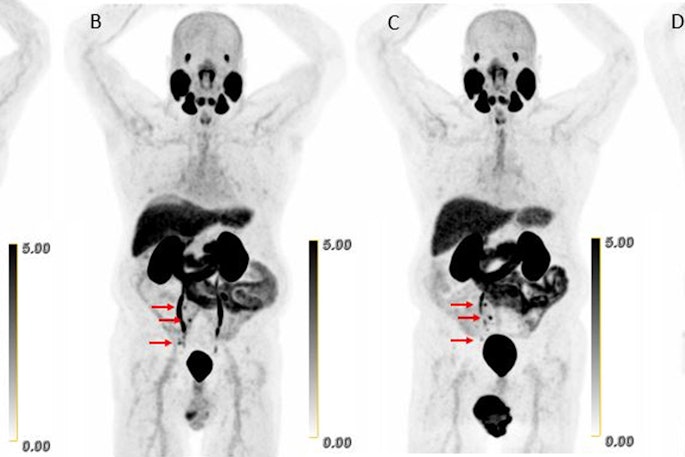 Scans in a 73-year-old man with biochemically recurrent prostate cancer (prostate-specific antigen level of 0.5 ng/mL) who underwent PET/CT with 9.4 mCi of F-18 piflufolastat and a second PET/CT examination with 8.1 mCi of copper 61-NODAGA (1,4,7-triazacyclononane,1-glutaric acid-4,7-acetic acid)–prostate-specific membrane antigen for imaging and therapy (Cu-61 PSMA I&T) 24 days apart, with no intervening therapy. Maximum intensity projection (MIP) images obtained (A) 1 hour after F-18 piflufolastat administration and (B) 1, (C) 2, and (D) 4 hours after Cu-61 PSMA I&T administration are shown. Physiologic uptake is seen in the lacrimal glands, salivary glands, liver, spleen, kidneys, ureters, and bladder. Pathologic uptake in pelvic nodal metastases is labeled with arrows. The F-18 piflufolastat PET/CT MIP image reveals two avid pelvic nodal metastases (arrows). Cu-61 PSMA I&T PET/CT scans demonstrate three avid pelvic nodal metastases on 1-hour and 2-hour images (arrows); five avid pelvic nodal metastases were suspected on the 4-hour image (arrows).