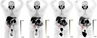 Scans in a 73-year-old man with biochemically recurrent prostate cancer (prostate-specific antigen level of 0.5 ng/mL) who underwent PET/CT with 9.4 mCi of F-18 piflufolastat and a second PET/CT examination with 8.1 mCi of copper 61-NODAGA (1,4,7-triazacyclononane,1-glutaric acid-4,7-acetic acid)–prostate-specific membrane antigen for imaging and therapy (Cu-61 PSMA I&T) 24 days apart, with no intervening therapy. Maximum intensity projection (MIP) images obtained (A) 1 hour after F-18 piflufolastat administration and (B) 1, (C) 2, and (D) 4 hours after Cu-61 PSMA I&T administration are shown. Physiologic uptake is seen in the lacrimal glands, salivary glands, liver, spleen, kidneys, ureters, and bladder. Pathologic uptake in pelvic nodal metastases is labeled with arrows. The F-18 piflufolastat PET/CT MIP image reveals two avid pelvic nodal metastases (arrows). Cu-61 PSMA I&T PET/CT scans demonstrate three avid pelvic nodal metastases on 1-hour and 2-hour images (arrows); five avid pelvic nodal metastases were suspected on the 4-hour image (arrows).