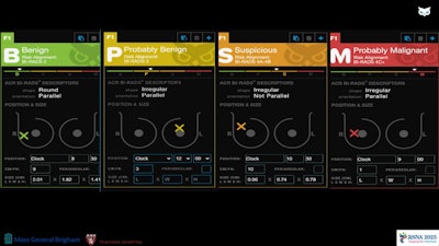 A study presented at RSNA 2025 showed the potential of an AI decision support tool to reduce unnecessary breast biopsies by about 60%. The images shows how the tool flags breast ultrasound findings.