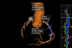 Syngo.CT Coronary Cockpit provides AI-powered cardiac plaque analysis.