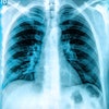 X Ray Chest Lungs