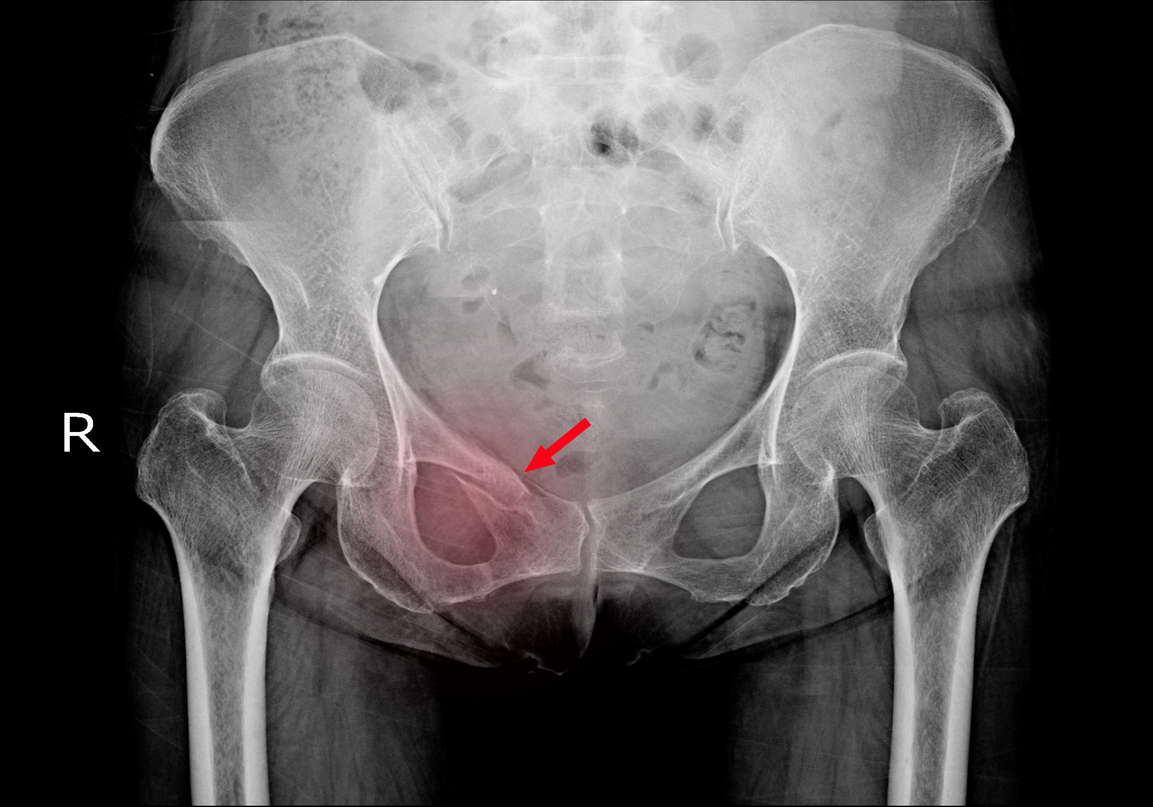 X Ray Pelvis Hip