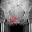 X Ray Pelvis Hip