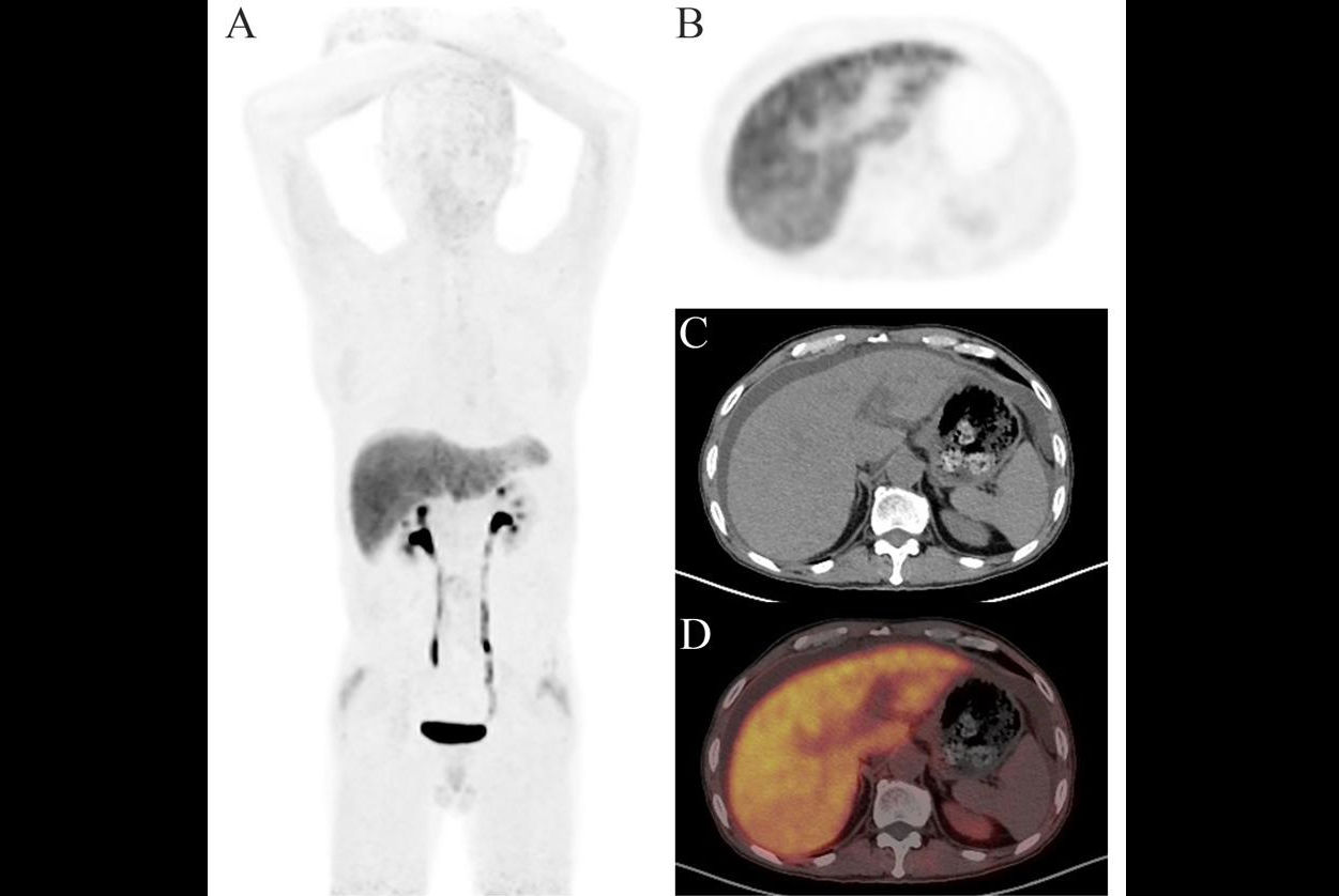 2025 01 12 Liver Fibrosis Thumbnail