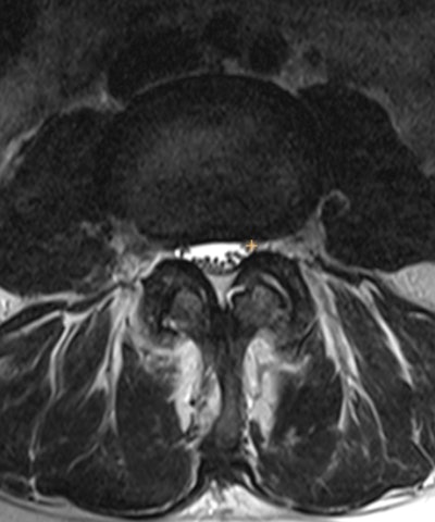 (A, B) MR images (A, sagittal T2; B, sagittal STIR) demonstrate the location of the localizers within the middle of the thecal sac at the level of the L1/L2 through L5/S1. Images and caption courtesy of the RSNA.
