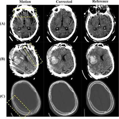 Visual examples of image quality improvements. (A) and (B) show corrections of motion artifacts within the brain tissue, where (A) corrects the star-like artifacts originating from the skull and (B) corrects the severe streaking artifacts across the brain. (C) shows the removal of a 'double skull' artifact caused by substantial head motion. Image display window is [0,80]HU for (A) and (B) and [−500, 1500]HU for (C). Images and caption courtesy of Academic Radiology.