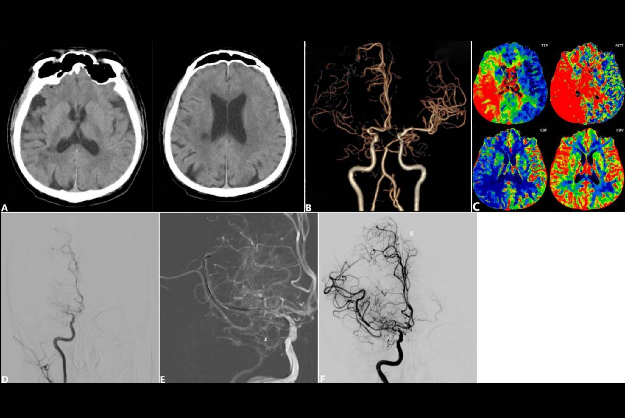 2026 01 06 Radiology Endo Recanalization Brain Ct Thumbnail