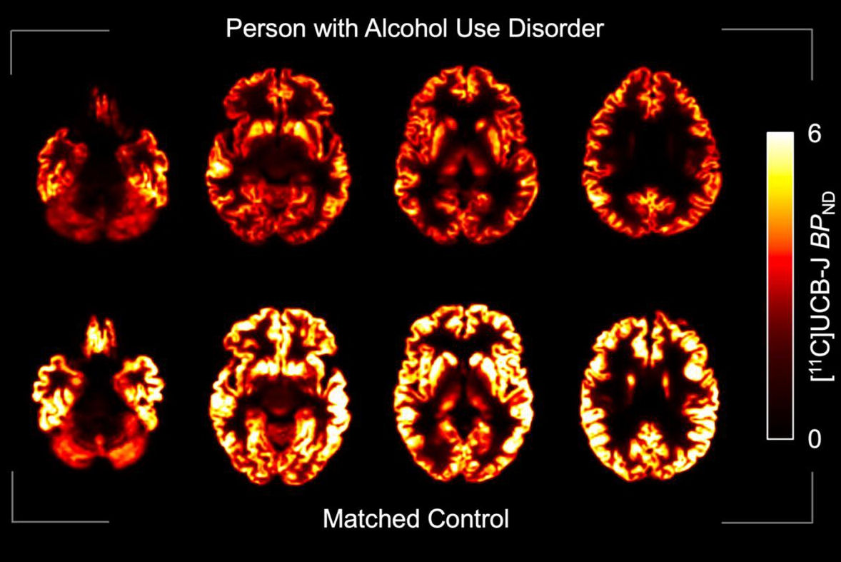 2026 01 15 Brain Synapse Density Thumbnail
