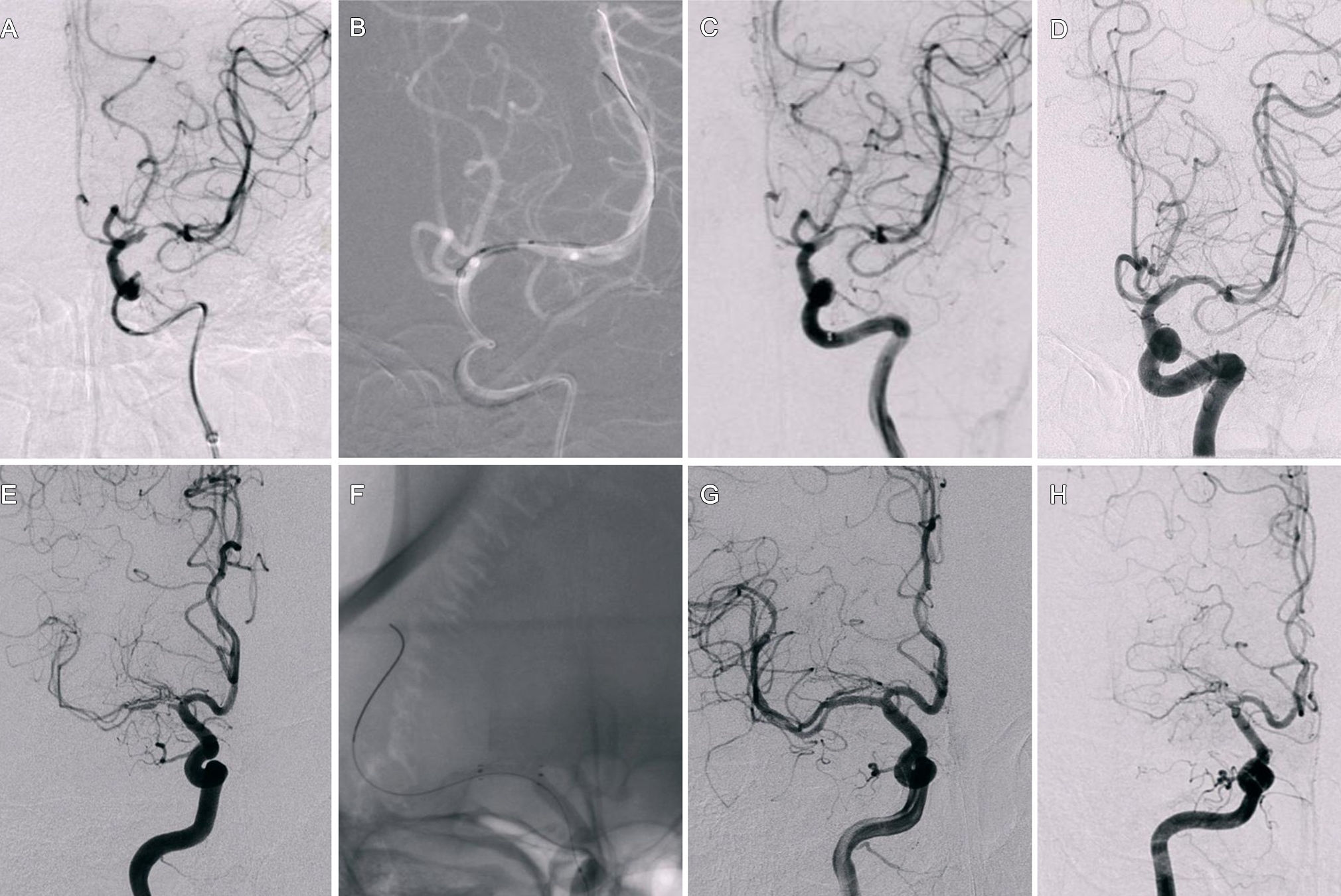2026 01 20 Drug Coated Balloon Procedure Thumbnail