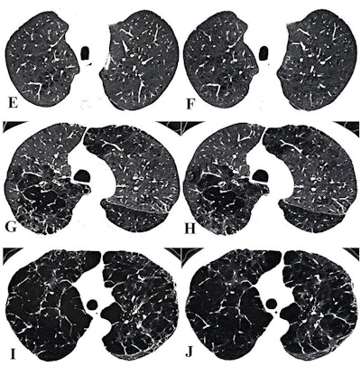(E) LD and (F) ULD images in an 83-year-old man. Readers categorized the participant as having moderate CLE (lucencies occupying >5% of the most severely affected lung zone) for both scans. (G) LD and (H) ULD images in an 83-year-old man. Readers categorized the participant as having confluent CLE for both scans. (I) LD and (J) ULD images in a 61-year-old man. Readers categorized the participant as having advanced destructive CLE for both scans.