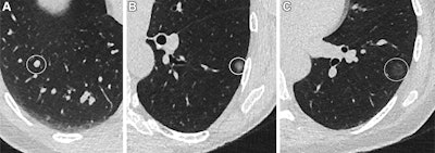 Transverse CT images show (A) a 120-mm3 solid pulmonary nodule, marked with a circle, in the right lower lobe in a 65-year-old male; (B) a 9-mm subsolid (part solid) nodule, marked with a circle, in the left lower lobe of a 57-year-old female; and (C) a 10-mm ground-glass nodule, marked with a circle, in the left lower lobe in a 52-year-old female.