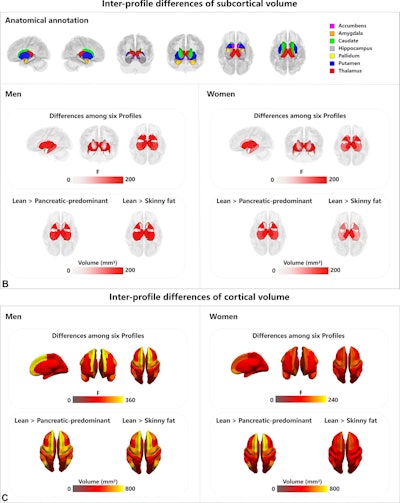 (B) Seven subcortical areas are shown (top). Sex-specific analysis shows overall interprofile differences in subcortical volume among the six fat distribution profiles (middle) and comparisons of two high-risk profiles (pancreatic predominant and skinny fat) against the benchmark profile (lean) (bottom). (C) Sex-specific analysis shows overall interprofile differences in cortical volume among the six fat distribution profiles (top) and comparisons of two high-risk profiles (pancreatic predominant and skinny fat) against the benchmark profile (lean) (bottom). For the diagrams showing the differences among the six profiles, the color scale indicates the F value. For the diagrams showing the mean difference between high-risk profiles and the benchmark profile, the color scale indicates the regional volume in the high-risk profile compared with the benchmark profile.