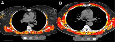 Example images of noncontrast, electrocardiographically gated coronary artery calcium CT (CAC CT) in the axial plane (section thickness, 2.5 mm). AI overlays show thoracic skeletal muscle (red) and intermuscular adipose tissue (yellow) for two MESA participants who never smoked, both with low emphysema-like lung percentage and evidence of myosteatosis, and who developed COPD during follow-up. (A) A 68-year-old female participant diagnosed with COPD 12 years after imaging. (B) A 69-year-old male participant diagnosed 5 years after imaging. AI = artificial intelligence, COPD = chronic obstructive pulmonary disease, MESA = Multi-Ethnic Study of Atherosclerosis, TSM = thoracic skeletal muscle.