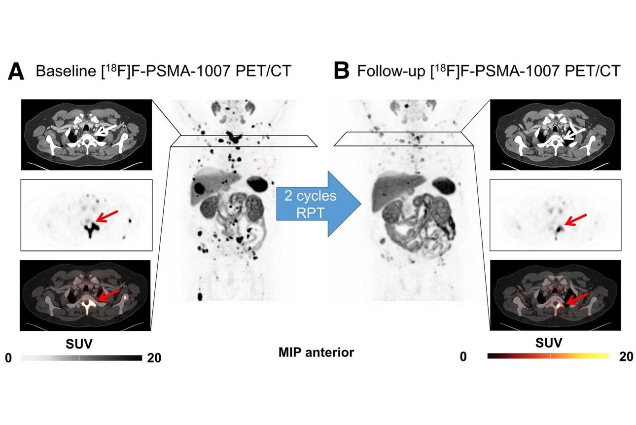 Ac 225 Psma Thumbnail