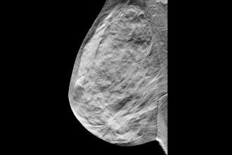 Breast Tomosynthesis Digital Social
