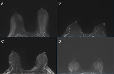 Examples of (A) minimal, (B) mild, (C) moderate, and (D) marked clinical background parenchymal enhancement (BPE) on subtracted postcontrast maximum intensity projection images.