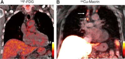 Cu-64 Macrin uptake in sarcoidosis patient. Coronal fused F-18 FDG-PET/CT scan (A) shows minimal uptake in paratracheal lymph nodes (F-18 FDG SUVmax, 2.2; hepatic SUVmean, 3.3). Coronal fused PET/MR at same level (B) reveals Macrin efficiently labeled paratracheal and hilar lymph nodes (arrows) (SUVmax, 6.6; hepatic SUVmean, 17) with biopsy-confirmed active inflammation.