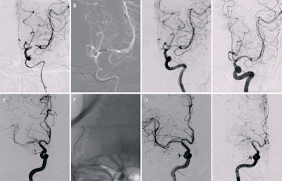Example angiographic images from drug-coated balloon (DCB) angioplasty and bare-metal stent (BMS) placement procedures. (A-D) Images in a 49-year-old female participant who underwent DCB (2 × 9 mm) angioplasty for severe stenosis in the M1 segment of the left middle cerebral artery. Images (A) before and (B) during the procedure are shown. (C) Image immediately after the procedure shows improvement of the stenosis. (D) Image at 6-month follow-up examination reveals no restenosis. (E-H) Images in a 55-year-old male participant who underwent BMS (2.5 × 9 mm) placement for severe stenosis in the M1 segment of the right middle cerebral artery. Images (E) before and (F) during the procedure are shown. (G) Image immediately after the procedure demonstrates significant improvement of the stenosis, but (H) image at 6-month follow-up examination shows the development of restenosis and occlusion.