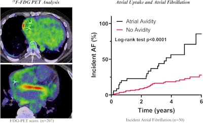 Representative axial and coronal F-18 FDG-PET/CT images demonstrate atrial metabolic activity. Kaplan-Meier analysis shows significantly higher cumulative incidence of AF in patients with atrial FDG avidity, the qualitative assessment of atrial FDG uptake, compared with those without avidity over the follow-up period (log-rank, p < 0.0001).