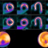Ischemia in the circumflex territory. F-18 flurpiridaz PET showed a perfusion defect in the lateral wall during pharmacological stress, which improved in rest. Myocardial blood flow (MBF) quantification showed decreased MBFstress (1.4 mL/min/g) and myocardial flow reserve (MFR) (2.2) in the circumflex (Cx) territory, with adequate flow in the left anterior descending and right coronary artery territories, MBFstress 2.6 and 2.2 mL/min/g, and MFR 3.4 and 3.1, respectively. Coronary angiography showed a 70%-99% stenosis in the Cx artery, for which percutaneous coronary intervention was performed with good result and good clinical outcome.