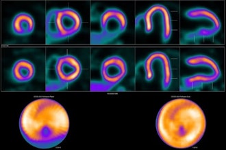 Ischemia in the circumflex territory. F-18 flurpiridaz PET showed a perfusion defect in the lateral wall during pharmacological stress, which improved in rest. Myocardial blood flow (MBF) quantification showed decreased MBFstress (1.4 mL/min/g) and myocardial flow reserve (MFR) (2.2) in the circumflex (Cx) territory, with adequate flow in the left anterior descending and right coronary artery territories, MBFstress 2.6 and 2.2 mL/min/g, and MFR 3.4 and 3.1, respectively. Coronary angiography showed a 70%-99% stenosis in the Cx artery, for which percutaneous coronary intervention was performed with good result and good clinical outcome.