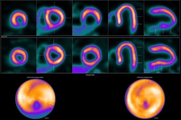 Ischemia in the circumflex territory. F-18 flurpiridaz PET showed a perfusion defect in the lateral wall during pharmacological stress, which improved in rest. Myocardial blood flow (MBF) quantification showed decreased MBFstress (1.4 mL/min/g) and myocardial flow reserve (MFR) (2.2) in the circumflex (Cx) territory, with adequate flow in the left anterior descending and right coronary artery territories, MBFstress 2.6 and 2.2 mL/min/g, and MFR 3.4 and 3.1, respectively. Coronary angiography showed a 70%-99% stenosis in the Cx artery, for which percutaneous coronary intervention was performed with good result and good clinical outcome.