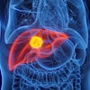Liver Cancer