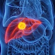 Liver Cancer