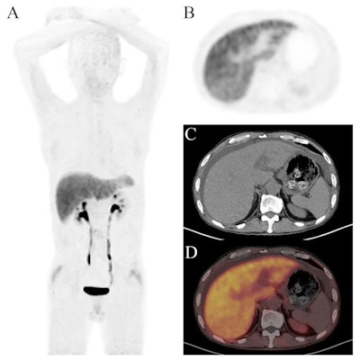 Images of a 55-year-old man with a 10-year history of hepatitis B virus infection. He presented with abdominal distension and yellowing of the skin and sclera for six months. The maximum intensity projection (MIP) image of Ga-68 FAPI-PET/CT showed diffuse tracer uptake in the liver region. Axial images showed significant liver uptake with abdominal effusion (SUVmean = 3.13; TBRliver-to-blood = 2.84; TLfap = 41.3). F4 level of liver fibrosis was confirmed by liver biopsy.