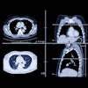 Lung Ct Images