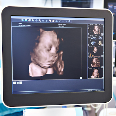 Ultrasound 3 D Fetal Head 400 (1)