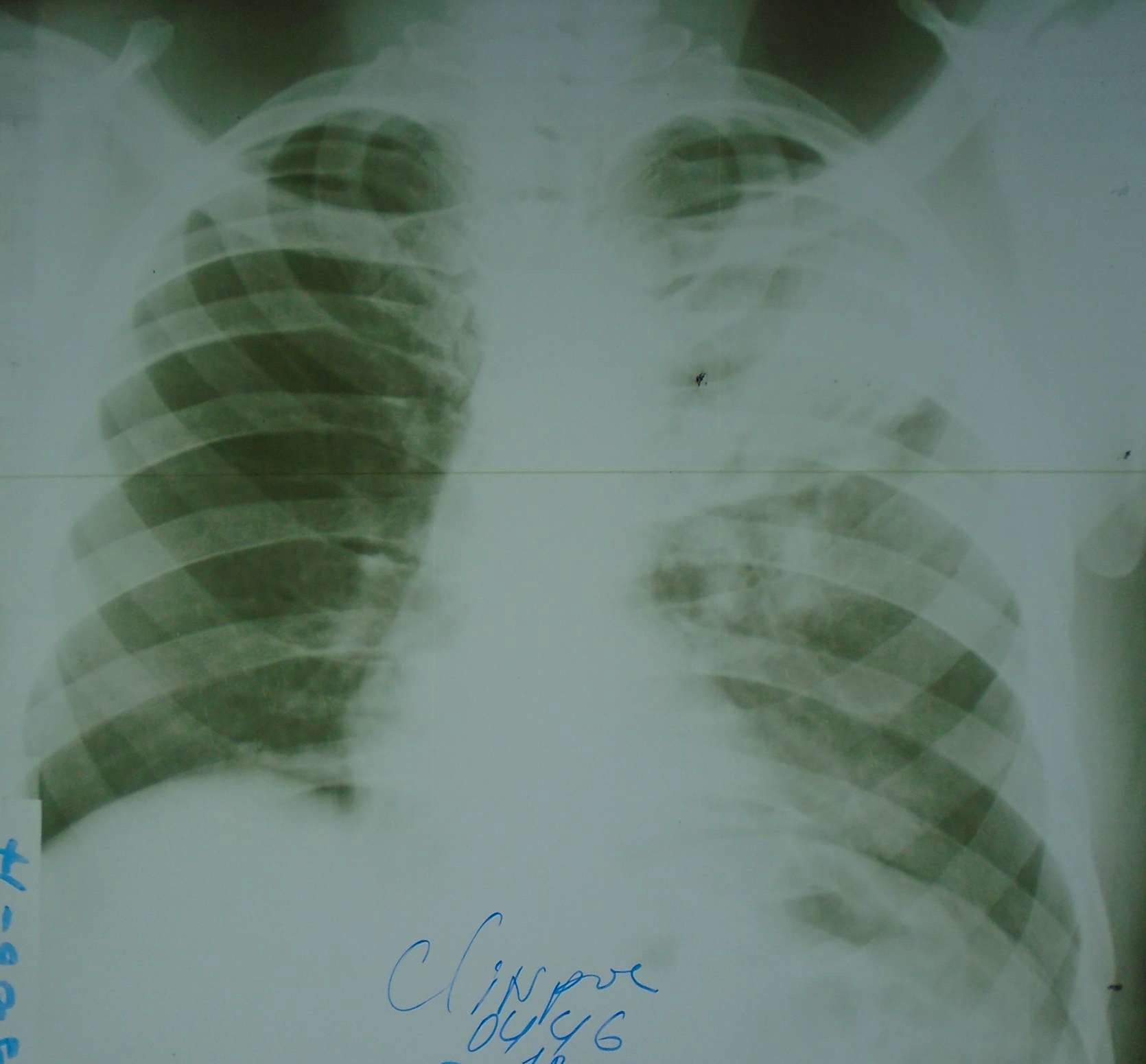 A sample input analyzed by the AI model. The film chest x-ray was photographed with a Sony Cyber-shot 20.1 MP digital camera.