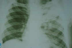 A sample input analyzed by the AI model. The film chest x-ray was photographed with a Sony Cyber-shot 20.1 MP digital camera.